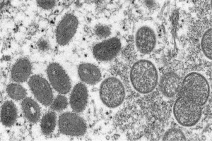 اكتشاف أول حالة إصابة بفيروس جدري القرود في روسيا